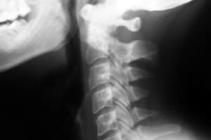 Radiografía. Una proyección de columna cervical