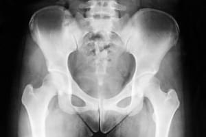 Radiografía. Una proyección de columna dorsal-lumbar