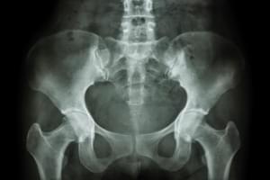 Radiografía. Una proyección de pelvis (ambas caderas)