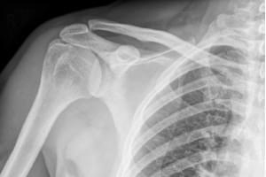 Radiografía. Una proyección de hombro, clavícula o  escápula