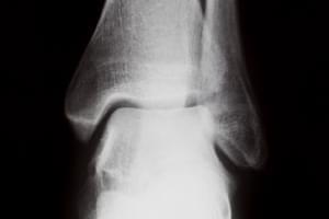 Radiografía. Una proyección de tobillo o pie