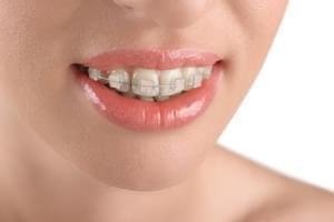 Ortodoncia fija estética de zafiro