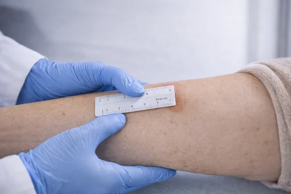 Test de Mantoux. Prueba de la tuberculina