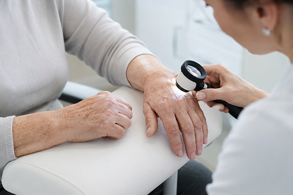 Consulta de Dermatología para manchas en la piel en Móstoles