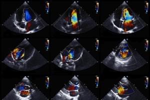Consulta de Cardiología + Electrocardiograma + Ecocardiograma