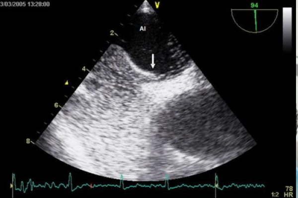 Ecocardiograma con Burbujas