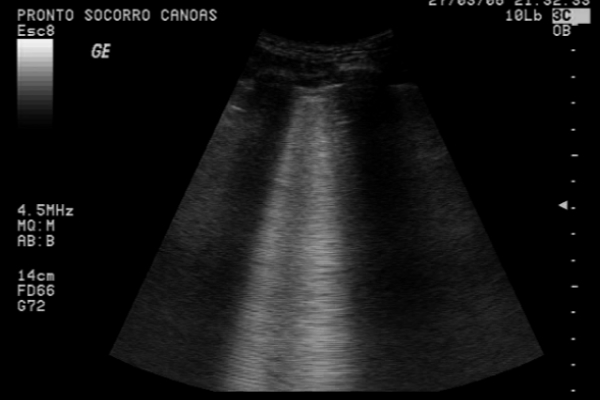 Eco Pulmonar