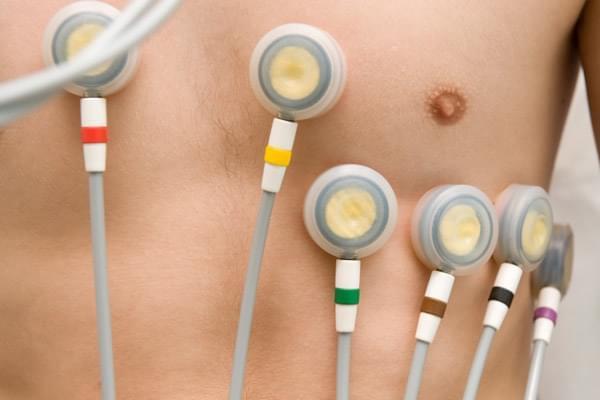 Holter de arritmia de 48 horas