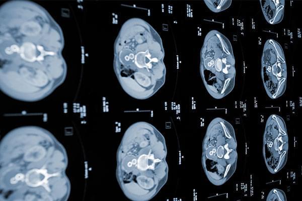 Eco Doppler de Carótidas