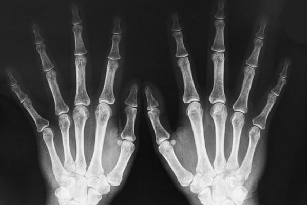 Rx Dedo AP Lateral