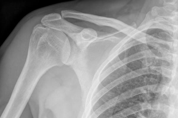 Rx Hombro AP Lateral